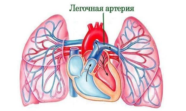 стеноз легочной артерии